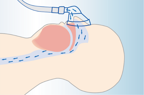 CPAP治療中のイラスト